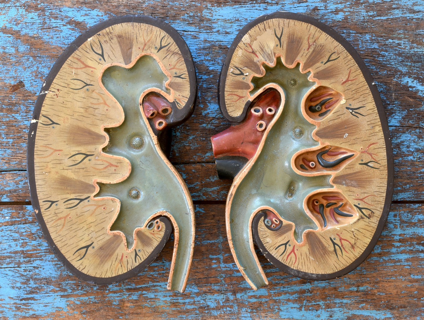 The Spare Kidney