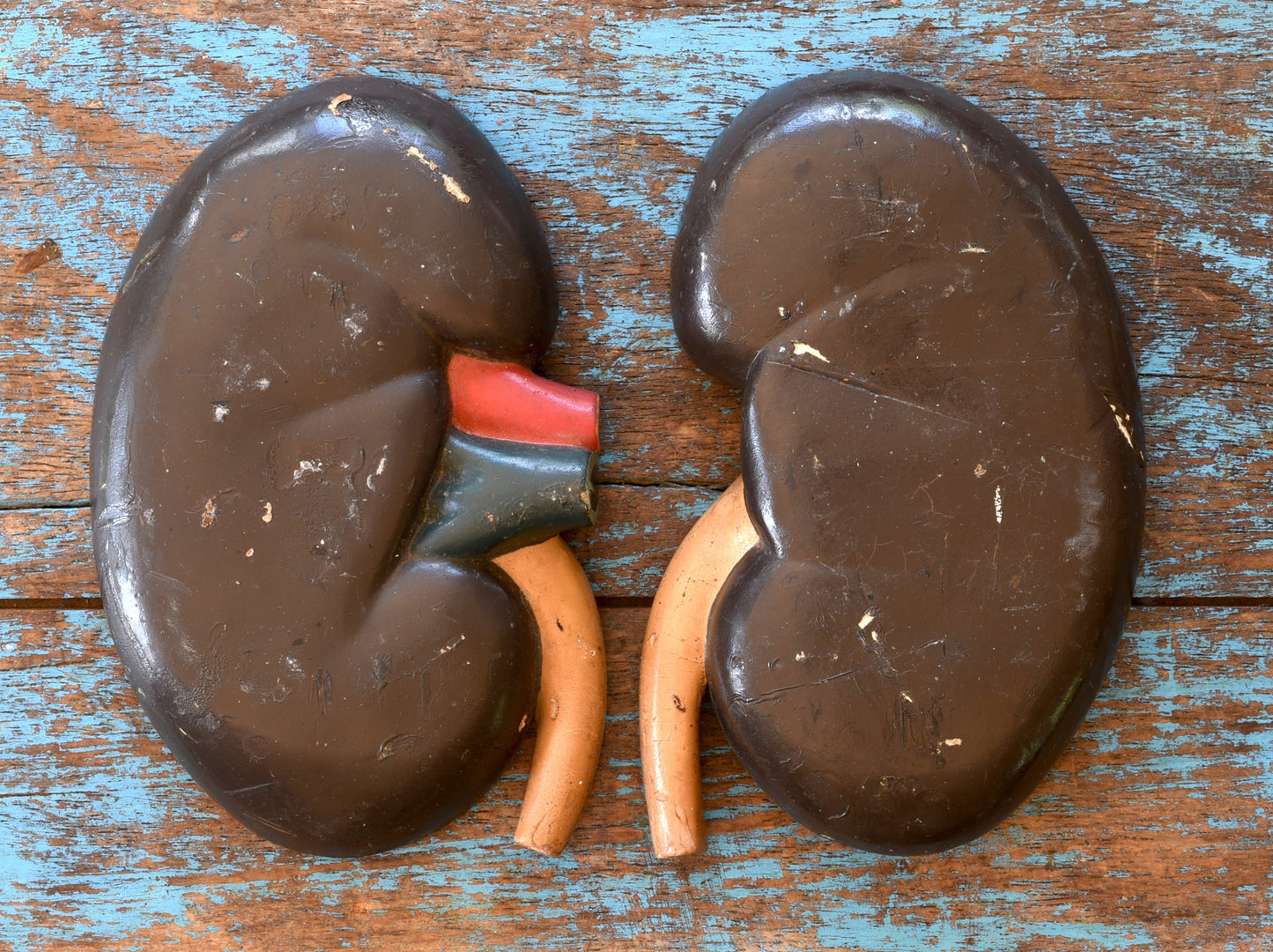 The Spare Kidney