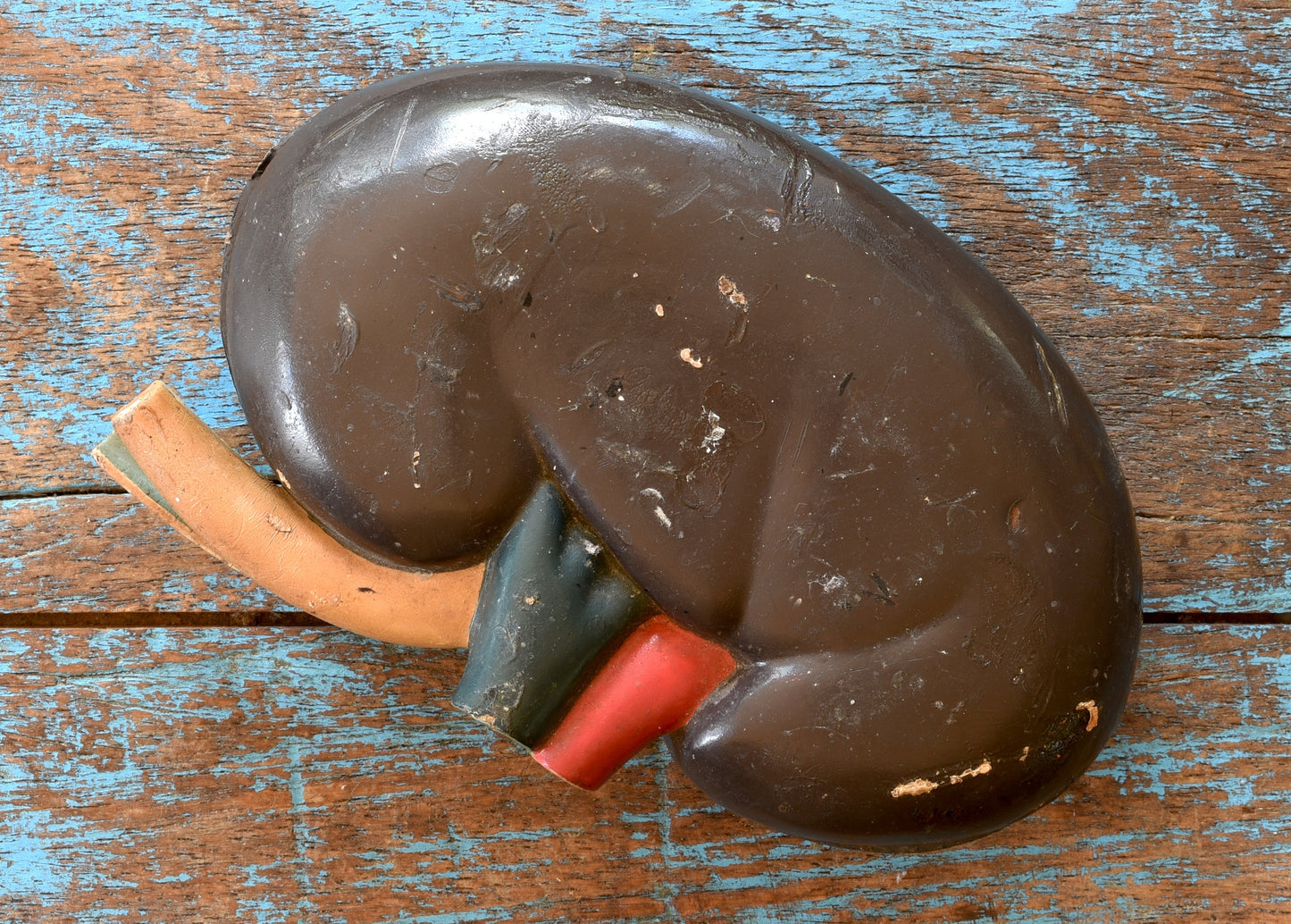The Spare Kidney